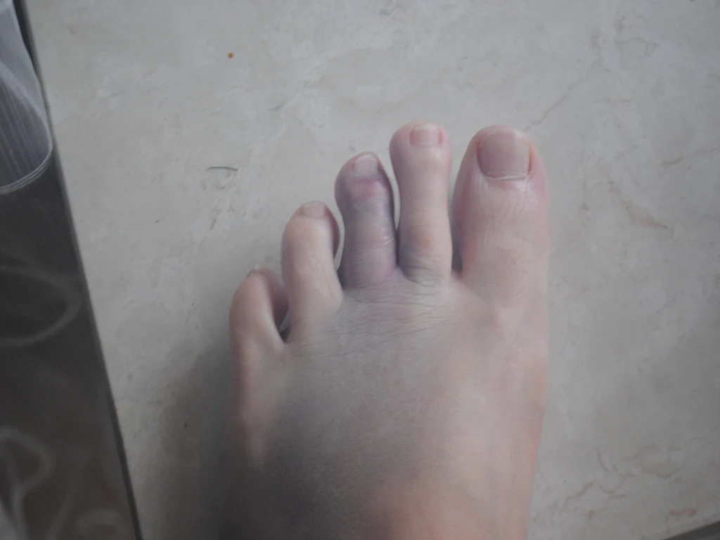 Hämatom nach der 8 VitaSoni<i>K</i>® Behandlung 