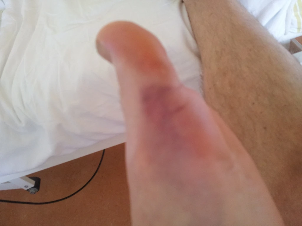 Hämatom vor der ersten VitaSoni<i>K</i>® - Behandlung  Bild 1