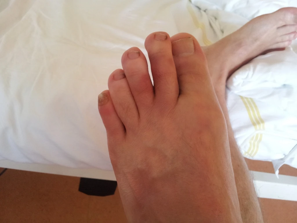 Hämatom vor der ersten VitaSoni<i>K</i>® - Behandlung  Bild 2