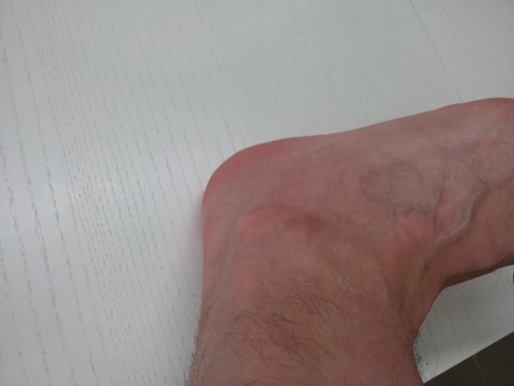 Hämatom (VitaSoni<i>K</i>® - Behandlung) nach 9 Tagen Bild 3