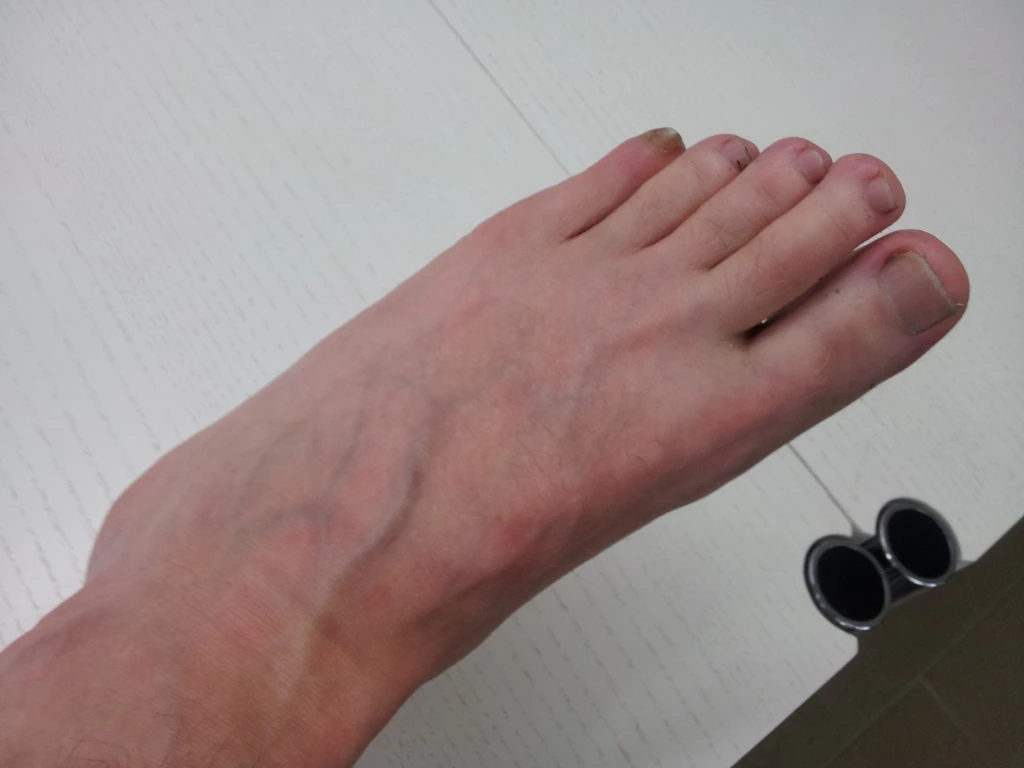 Hämatom (VitaSoni<i>K</i>® - Behandlung) nach 9 Tagen Bild 2
