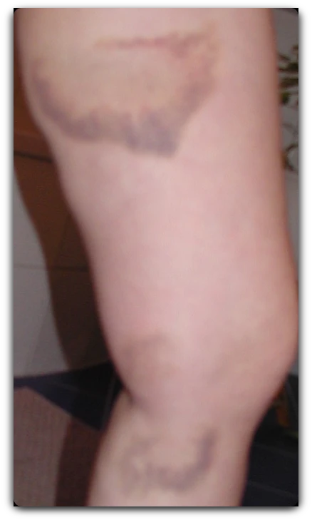 Hämatom nach der 1 VitaSoni<i>K</i>® MED Behandlung