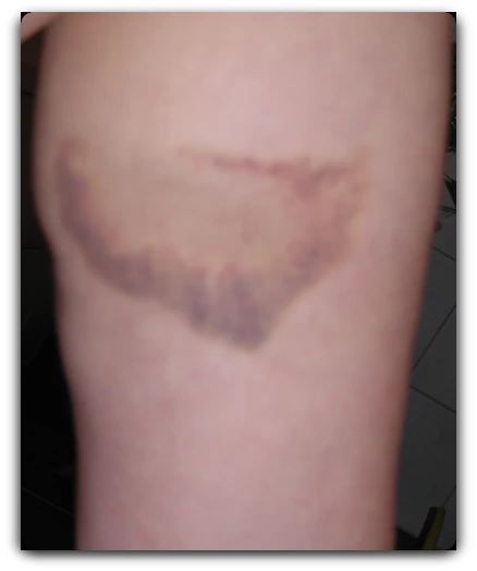 Hämatom nach der 2 VitaSoni<i>K</i>® MED Behandlung